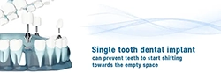 Single tooth dental implant