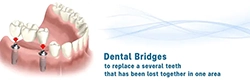 Dental Bridges