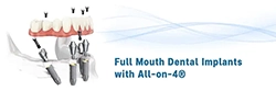 Full Mouth Dental Implants