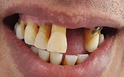 Let the MALO dental implants fulfill and complete your life