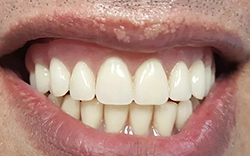 Let the MALO dental implants fulfill and complete your life