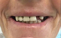 Let the MALO dental implants fulfill and complete your life