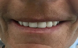 Let the MALO dental implants fulfill and complete your life