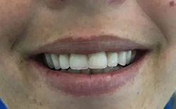 Let the MALO dental implants fulfill and complete your life