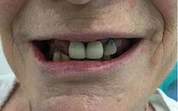 Let the MALO dental implants fulfill and complete your life