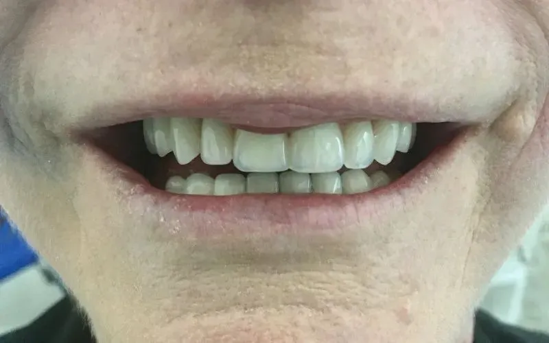 Let the MALO dental implants fulfill and complete your life