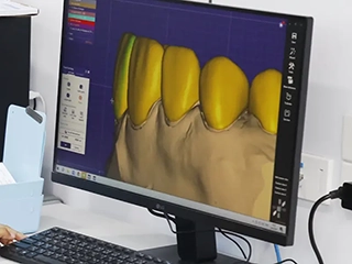 Tooth Preparation design