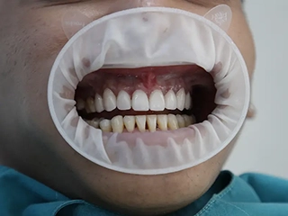 Fixed for the dental veneer
