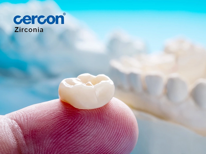 CERCON® Zirconia - a bridge must not look like a bridge!