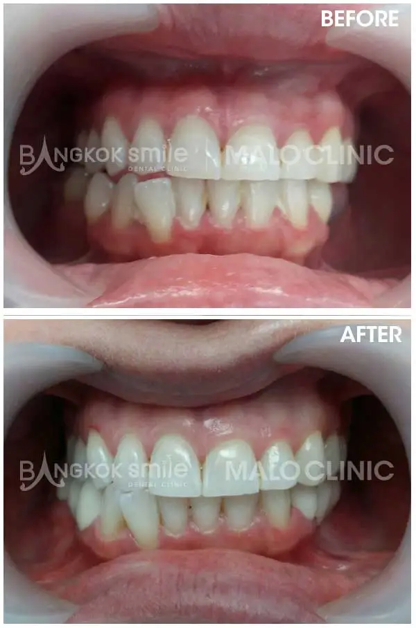 Dental Crowns & Bridges Clinical Case Gallery