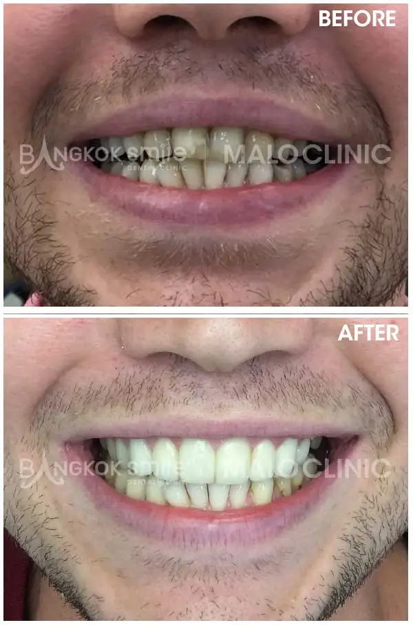 Dental Crowns & Bridges Clinical Case Gallery