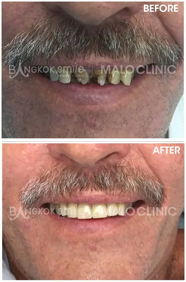 Dental Crowns & Bridges Clinical Case Gallery