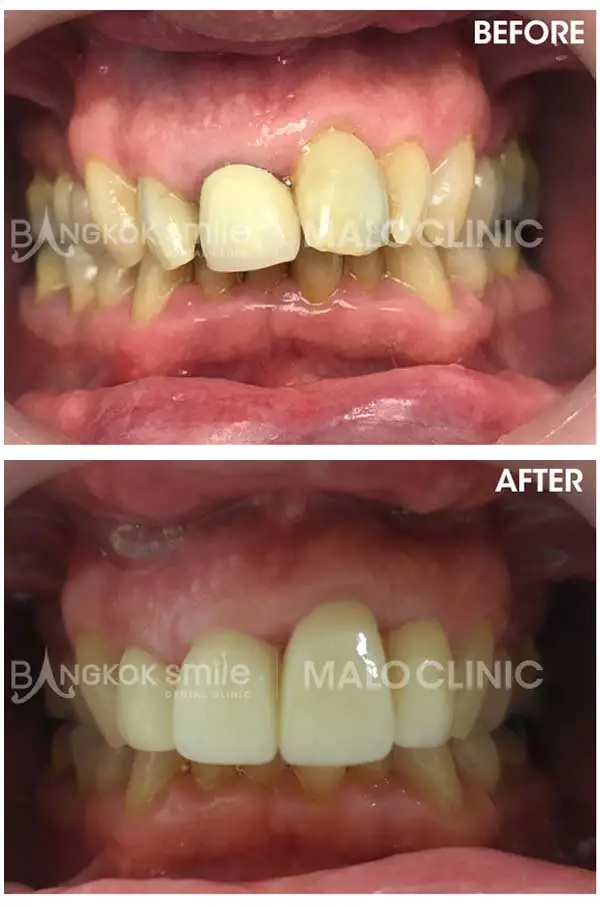 Dental Crowns & Bridges Clinical Case Gallery
