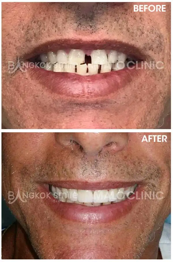 Dental Crowns & Bridges Clinical Case Gallery