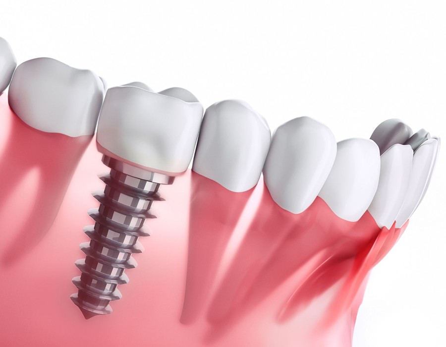 dental implants