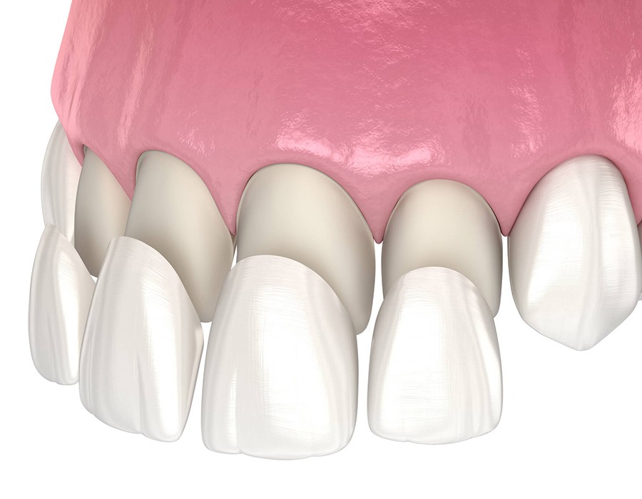 dental veneers