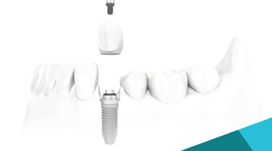 Meet Prosthodontist and Get dental implants @Bangkok Smile MALO CLINIC