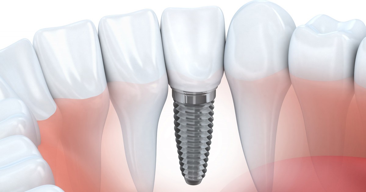 dental clinic bangkok, thailand tooth implants