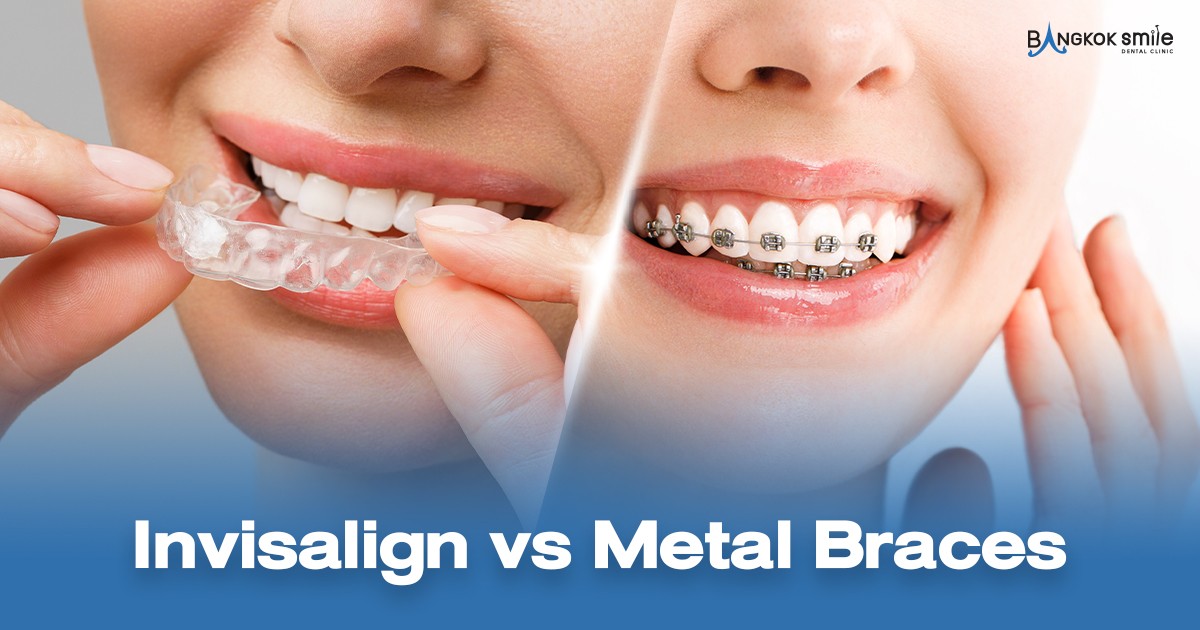 Clear Comparison Invisalign vs. Metal Braces