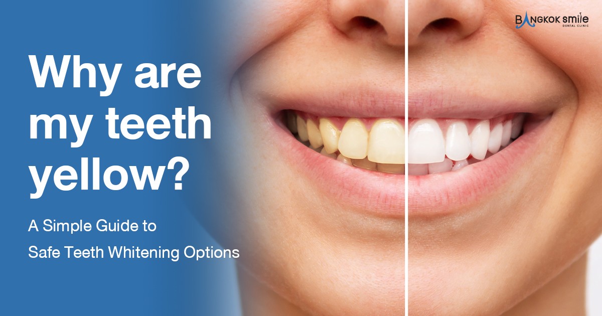 Why are my teeth yellow? A Simple Guide to Safe Teeth Whitening Options