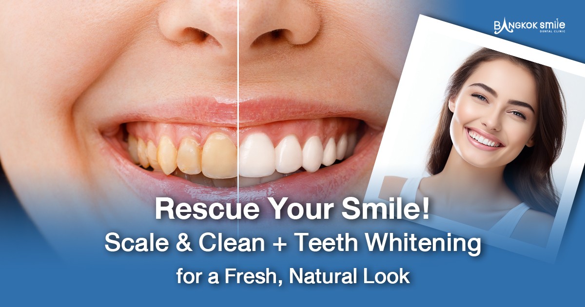 Review Rescue Your Smile! Scale & Clean + Teeth Whitening for a Fresh, Natural Look