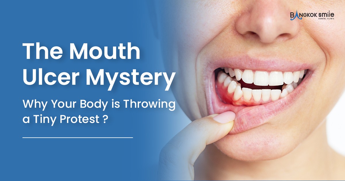 Mouth Ulcers: Small Spots, Big Reminders to Take Care of Yourself