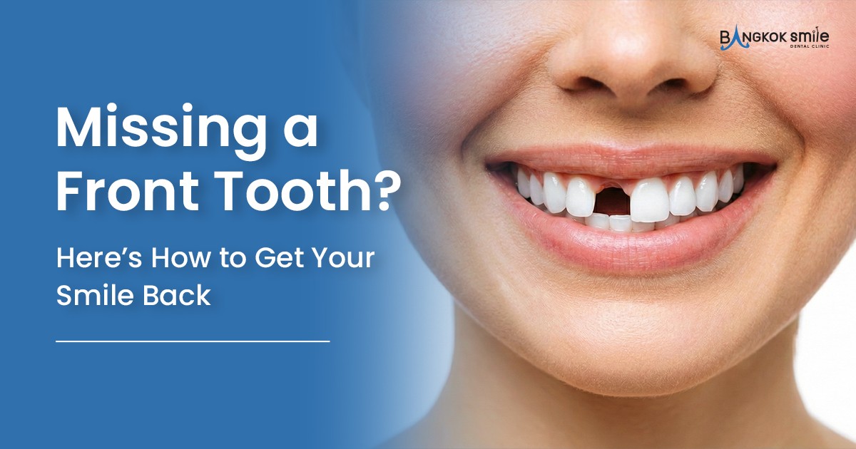 Missing a Front Tooth? Here’s How to Get Your Smile Back