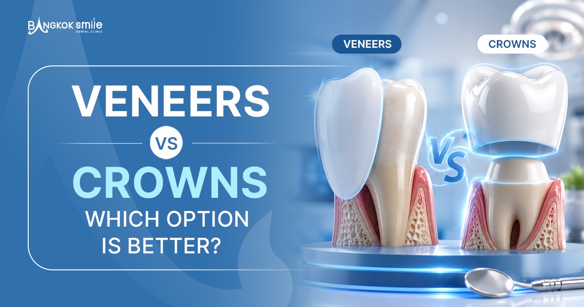 Veneers vs Crowns: Which Option Is Better?
