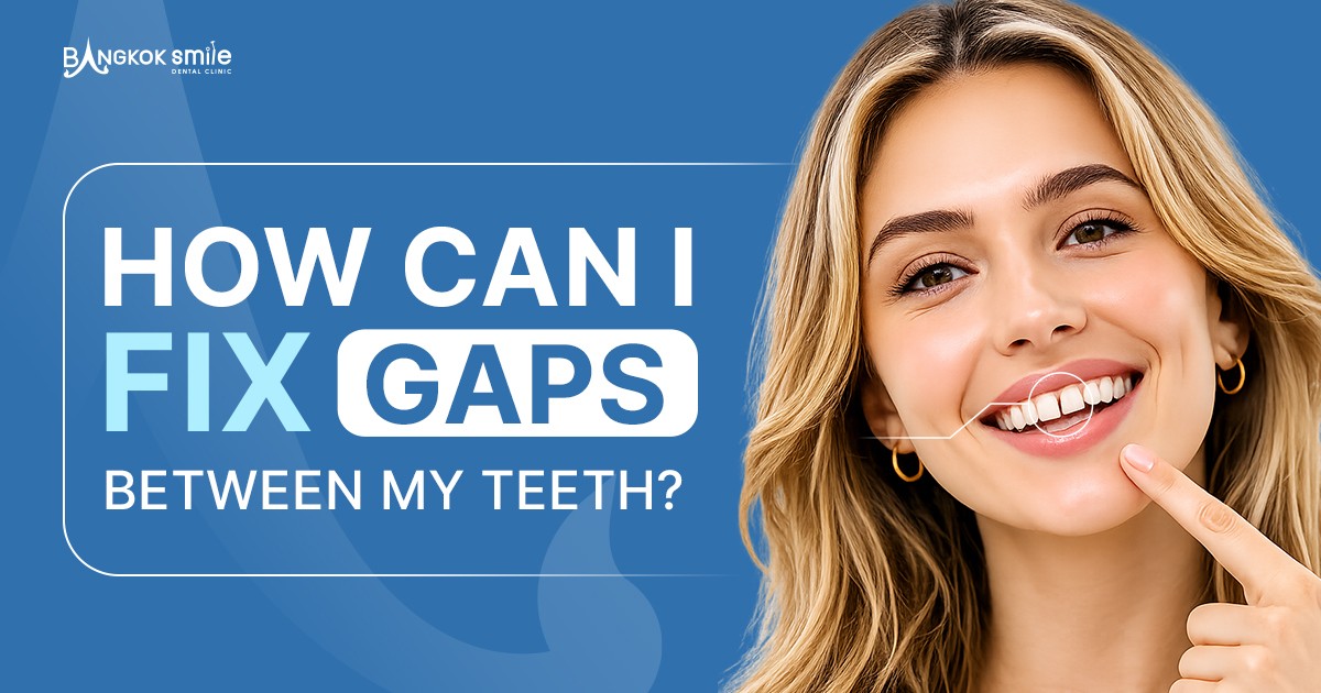 How Can I Fix Gaps Between My Teeth?