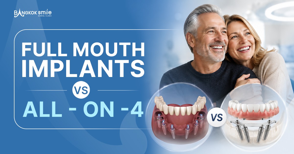 Full Mouth Implants vs All -on  4