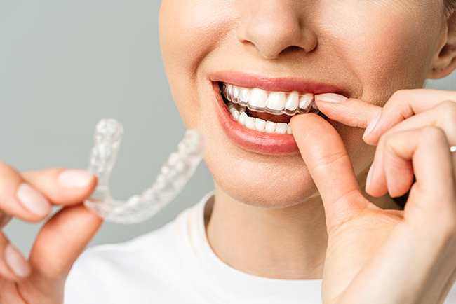 What is INVISALIGN™?